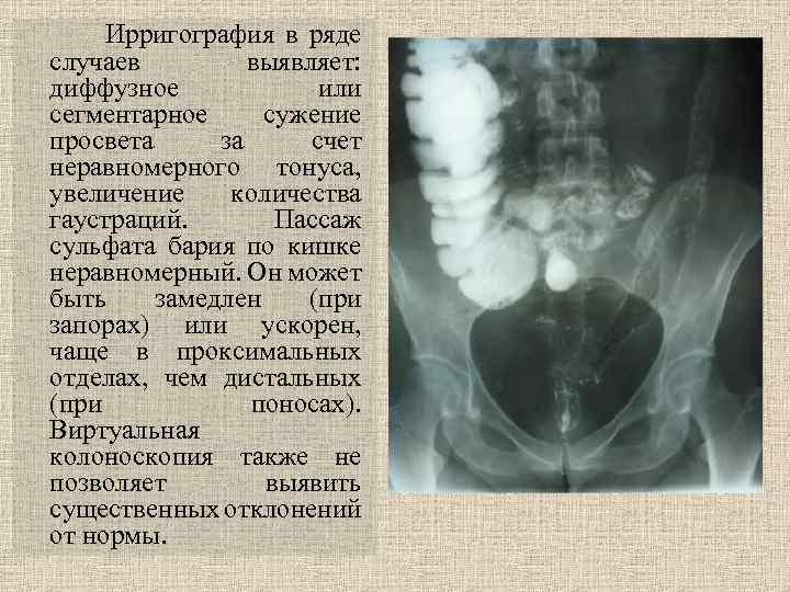 Пассаж кишки. Гаустрация в сигмовидной кишке. Сглаженность гаустр в кишечнике. Гаустрация толстой кишки выражена.