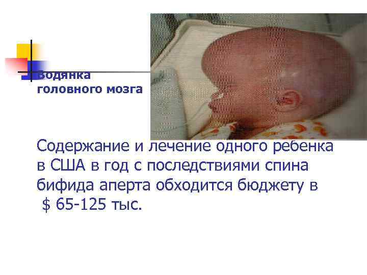 Водянка головного мозга Содержание и лечение одного ребенка в США в год с последствиями