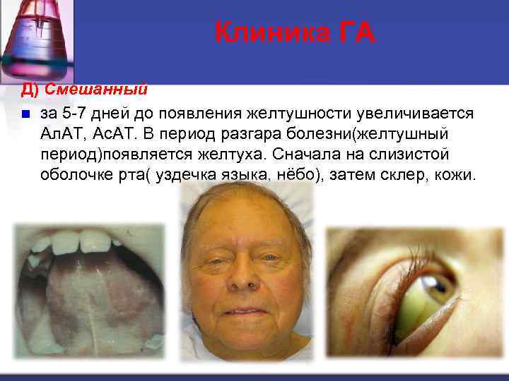 Клиника ГА. Д) Смешанный n за 5 -7 дней до появления желтушности увеличивается Ал.