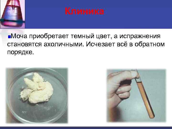 Клиника Моча приобретает темный цвет, а испражнения становятся ахоличными. Исчезает всё в обратном порядке.