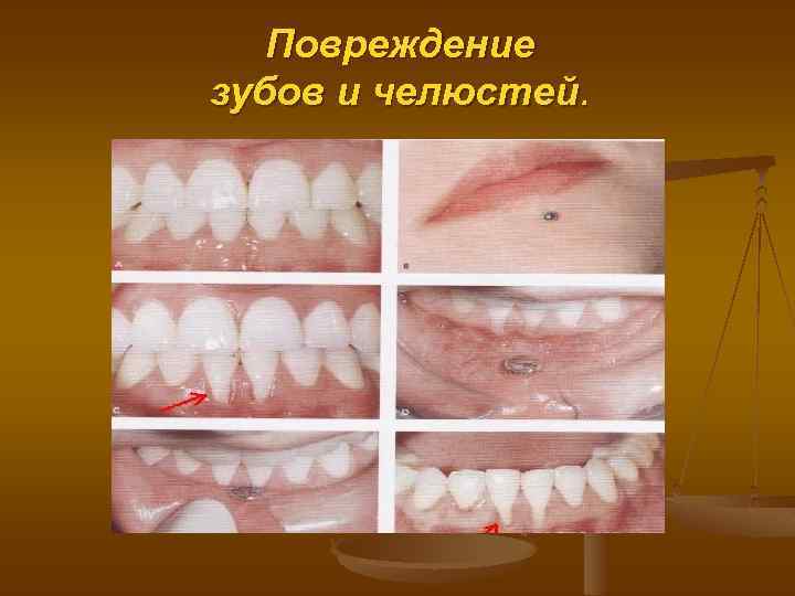 Повреждение зубов и челюстей. 