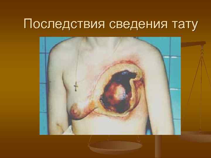 Последствия сведения тату 