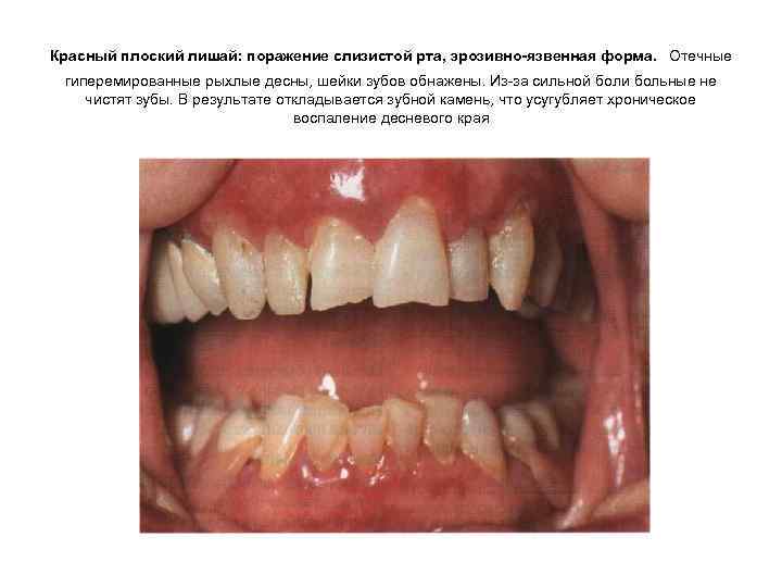 Красный плоский лишай: поражение слизистой рта, эрозивно-язвенная форма. Отечные гиперемированные рыхлые десны, шейки зубов