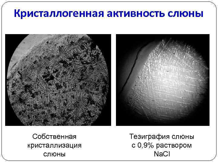Кристаллогенная активность слюны Собственная кристаллизация слюны Тезиграфия слюны с 0, 9% раствором Na. Cl