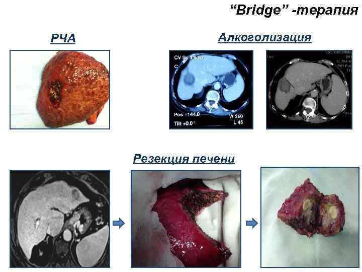“Bridge” -терапия РЧА Алкоголизация Резекция печени 