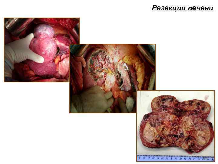 Резекции печени 