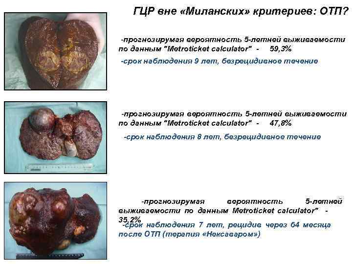 ГЦР вне «Миланских» критериев: ОТП? -прогнозирумая вероятность 5 -летней выживаемости по данным 