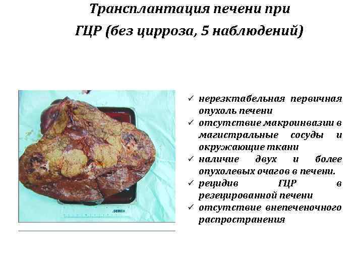 Трансплантация печени при ГЦР (без цирроза, 5 наблюдений) ü ü ü нерезктабельная первичная опухоль