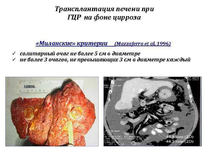 Трансплантация печени при ГЦР на фоне цирроза «Миланские» критерии ü ü (Mazzaferro et al,