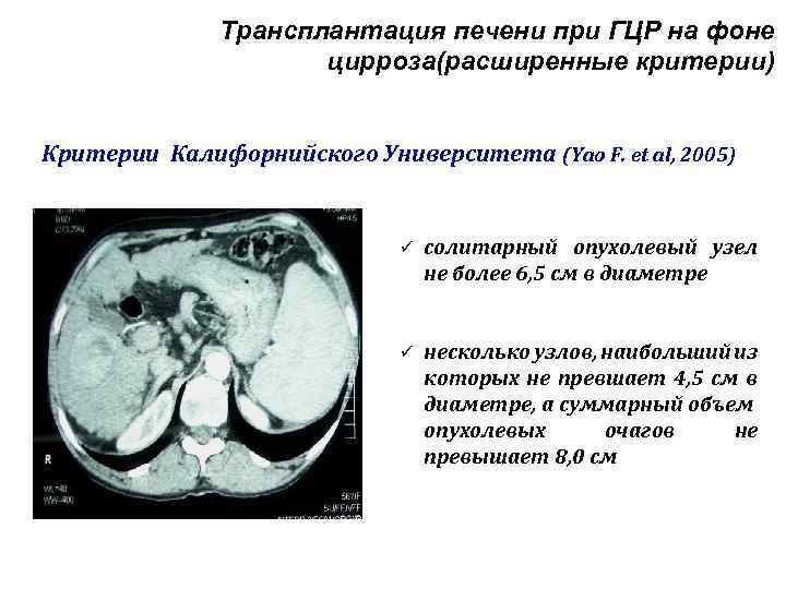 Трансплантация печени при ГЦР на фоне цирроза(расширенные критерии) Критерии Калифорнийского Университета (Yao F. et