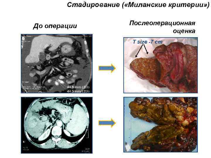 Стадирование ( «Миланские критерии» ) До операции Послеоперационная оценка T size -7 cm 