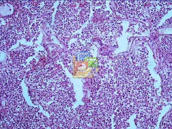 Виды общей патологической атрофии (истощения): алиментарная (при голодании или нарушении усвоения пищи); при раковой