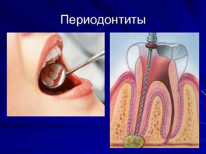 Периодонтиты 