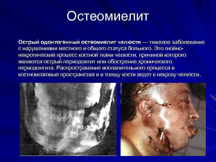 Остеомиелит Острый одонтогенный остеомиелит челюсти — тяжелое заболевание с нарушениями местного и общего статуса