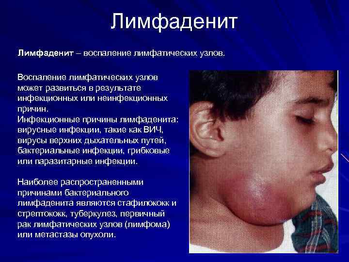 Лимфаденит – воспаление лимфатических узлов. Воспаление лимфатических узлов может развиться в результате инфекционных или