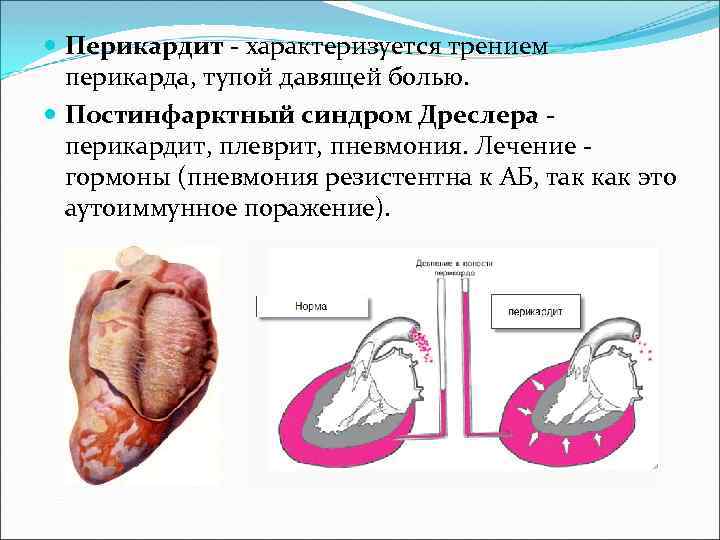  Перикардит - характеризуется трением перикарда, тупой давящей болью. Постинфарктный синдром Дреслера - перикардит,