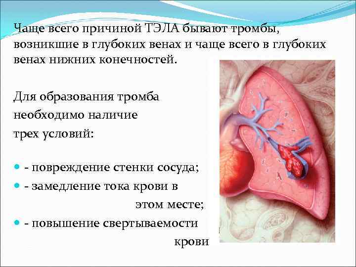 Чаще всего причиной ТЭЛА бывают тромбы, возникшие в глубоких венах и чаще всего в