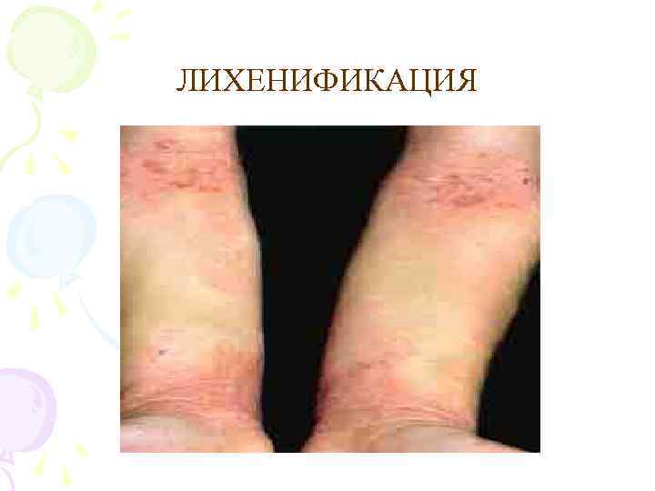 ЛИХЕНИФИКАЦИЯ 