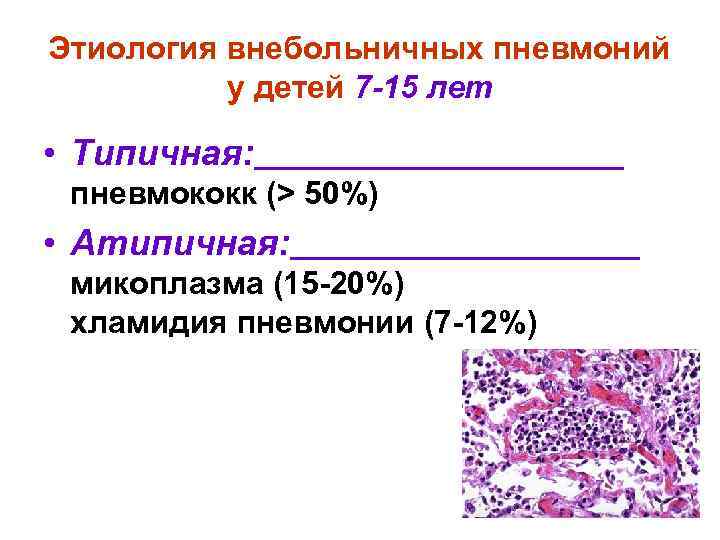 Этиология внебольничных пневмоний у детей 7 -15 лет • Типичная: пневмококк (> 50%) •
