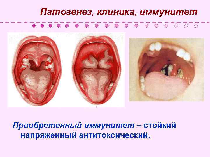  Патогенез, клиника, иммунитет Приобретенный иммунитет – стойкий напряженный антитоксический. 