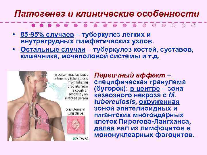 Патогенез и клинические особенности • 85 -95% случаев – туберкулез легких и внутригрудных лимфатических