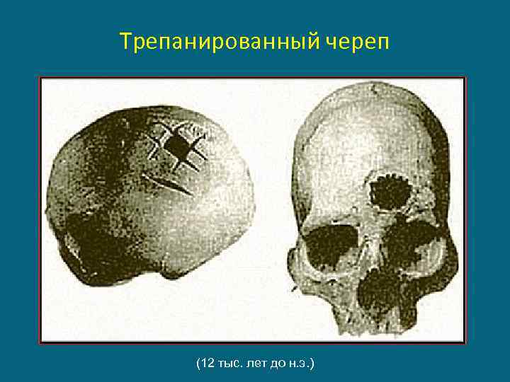 Трепанированный череп (12 тыс. лет до н. э. ) 