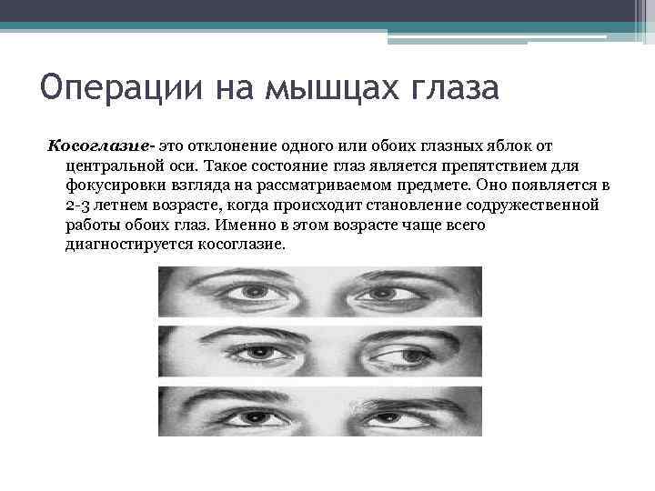Операции на мышцах глаза Косоглазие- это отклонение одного или обоих глазных яблок от центральной