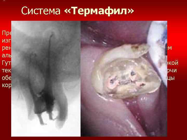  • Система «Термафил» Представляет собой гибкий конусообразный стержень, изготовленный из нержавеющей стали, титана