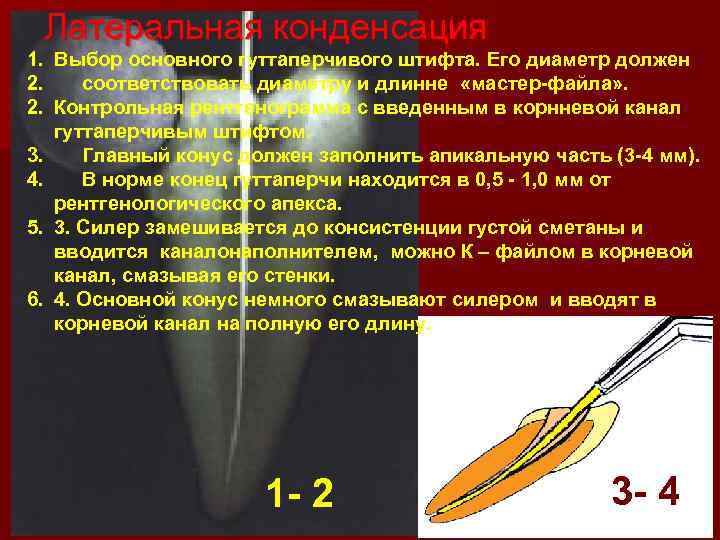 Пломбирование канала латеральной конденсацией. Латеральная конденсация гуттаперчи этапы. Метод латеральной конденсации для пломбирования корневых каналов. Ошибки пломбирования корневого канала. Протокол пломбирования корневых каналов.