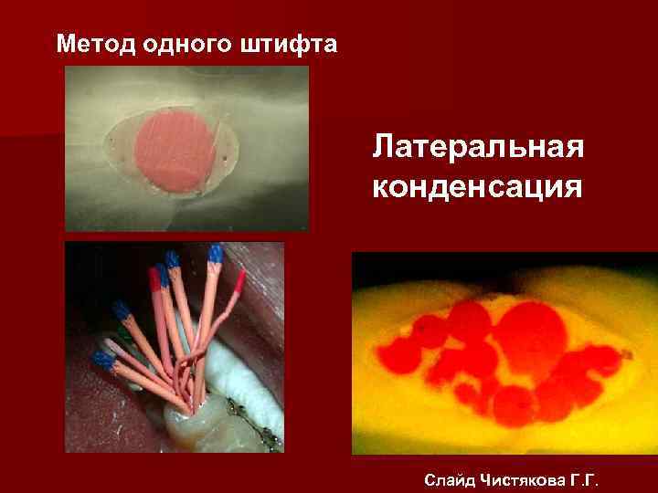 Методика пломбирования с использованием каналонаполнителя. Метод одного штифта. Метод одного штифта. Пломбирование каналов методом 1 штифта. Метод пломбирования корневого канала с использованием 1 штифта схема.
