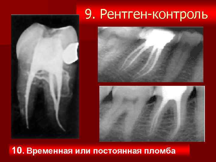 9. Рентген-контроль 10. Временная или постоянная пломба 