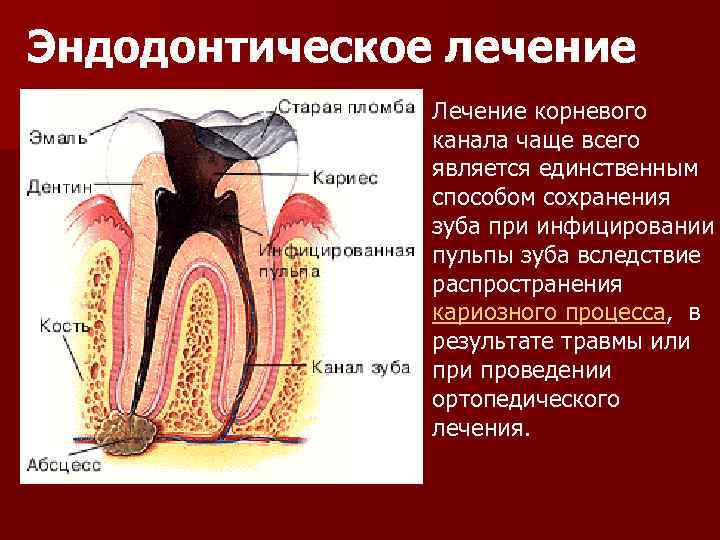 Осложнения эндодонтического лечения. Лечение корневых каналов. Эндолечение зуба этапы. Ошибки и осложнения при пломбировании корневых каналов. Этапы эндодонтической обработки корневых каналов.