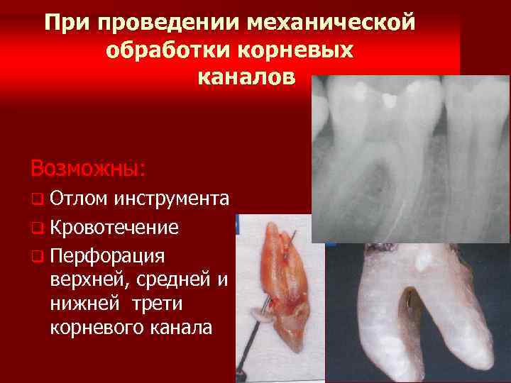 Методы пломбирования корневых каналов презентация