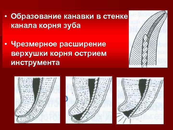 Расширение каналов. Продольная перфорация стенки корневого канала. Чрезмерное расширение корневого канала. Апикальная перфорация стенки корневого канала.