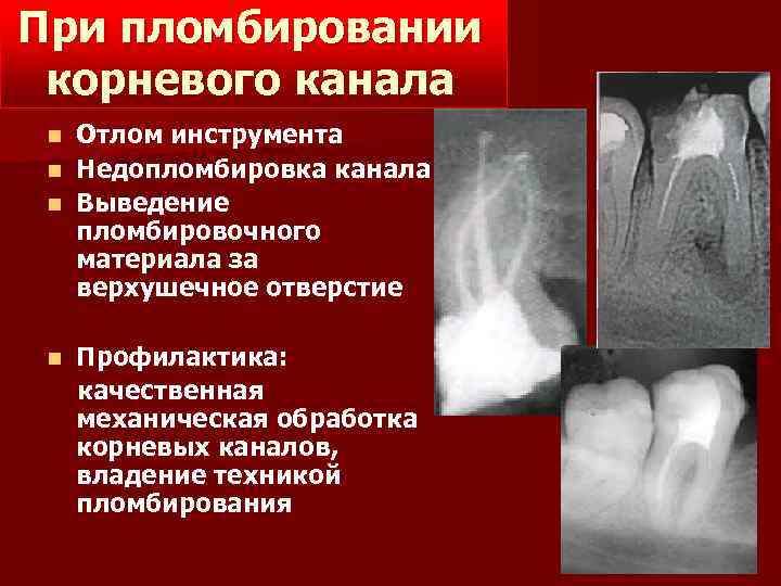 При пломбировании корневого канала n n Отлом инструмента Недопломбировка канала Выведение пломбировочного материала за