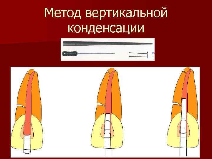 Метод латеральной конденсации презентация