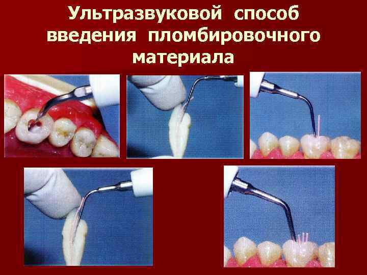 Ультразвуковой способ введения пломбировочного материала 