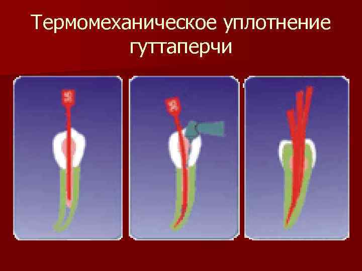 Метод латеральной конденсации презентация