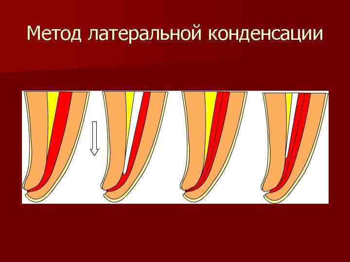 Пломбирование канала латеральной конденсацией