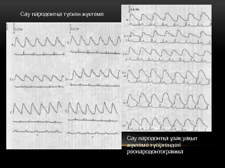 Сау пародонтқа түскен жүктеме Сау пародонтқа ұзақ уақыт жүктеме түсіргендегі реопародонтограмма 