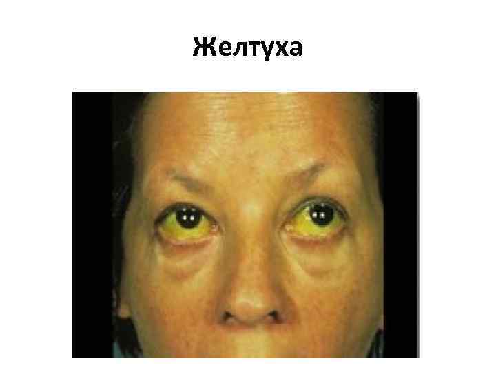 Желтуха 