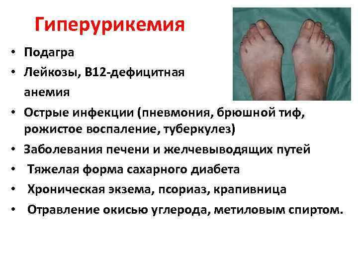 Гиперурикемия • Подагра • Лейкозы, В 12 -дефицитная анемия • Острые инфекции (пневмония, брюшной