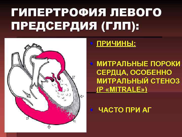 ГИПЕРТРОФИЯ ЛЕВОГО ПРЕДСЕРДИЯ (ГЛП): § ПРИЧИНЫ: § МИТРАЛЬНЫЕ ПОРОКИ СЕРДЦА, ОСОБЕННО МИТРАЛЬНЫЙ СТЕНОЗ (Р