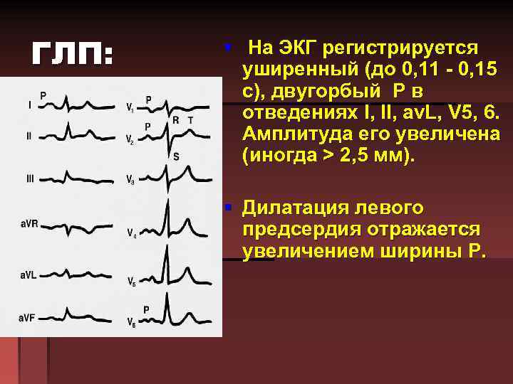 ГЛП: § На ЭКГ регистрируется уширенный (до 0, 11 - 0, 15 с), двугорбый