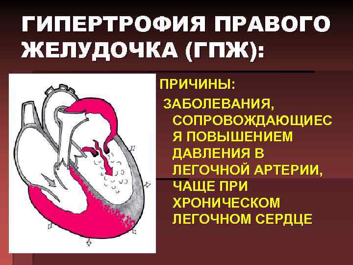 ГИПЕРТРОФИЯ ПРАВОГО ЖЕЛУДОЧКА (ГПЖ): ПРИЧИНЫ: ЗАБОЛЕВАНИЯ, СОПРОВОЖДАЮЩИЕС Я ПОВЫШЕНИЕМ ДАВЛЕНИЯ В ЛЕГОЧНОЙ АРТЕРИИ, ЧАЩЕ