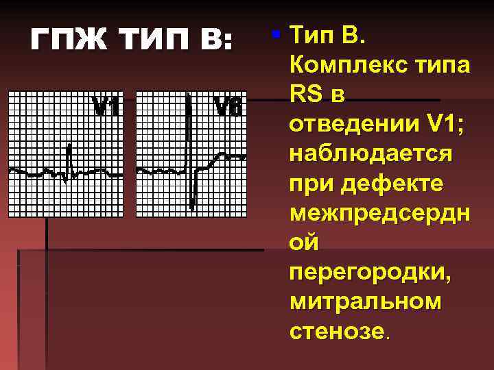 ГПЖ ТИП В: § Тип B. Комплекс типа RS в отведении V 1; наблюдается