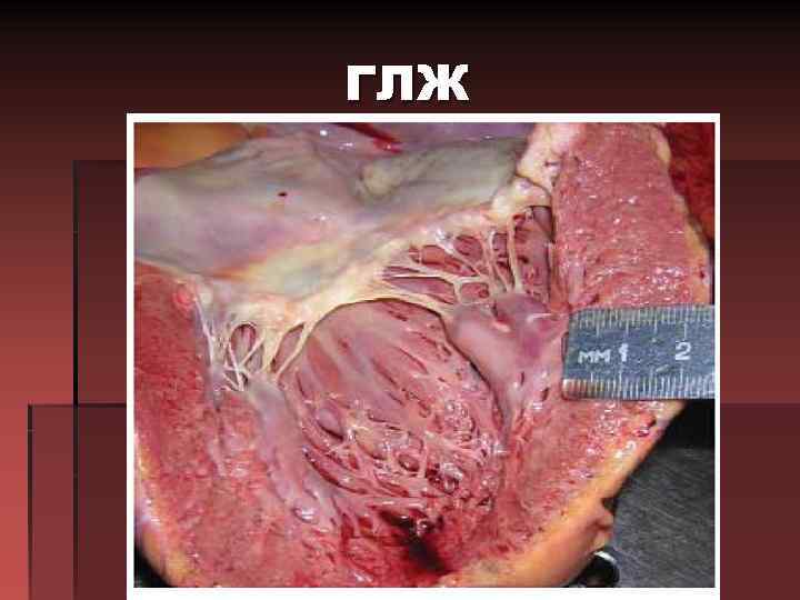 ГЛЖ 