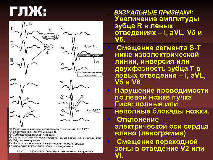 ГЛЖ: ВИЗУАЛЬНЫЕ ПРИЗНАКИ: § § Увеличение амплитуды зубца R в левых отведениях – I,
