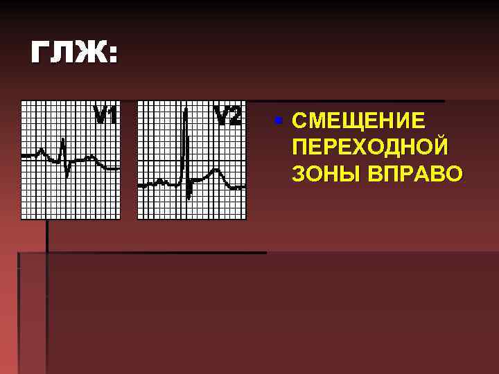 ГЛЖ: § СМЕЩЕНИЕ ПЕРЕХОДНОЙ ЗОНЫ ВПРАВО 