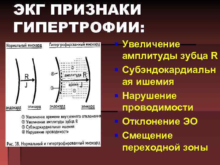 ЭКГ ПРИЗНАКИ ГИПЕРТРОФИИ: § Увеличение амплитуды зубца R § Субэндокардиальн ая ишемия § Нарушение